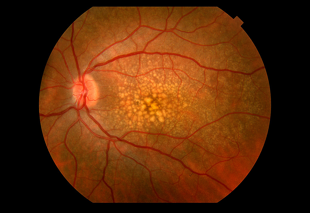 Drusen are yellow spots on the macula in the center of the retina.